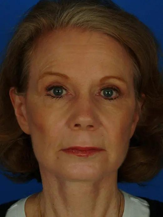 Facial Plastic Surgery Associates facelift after — Houston, TX