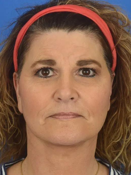Facial Plastic Surgery Associates facelift after — Houston, TX