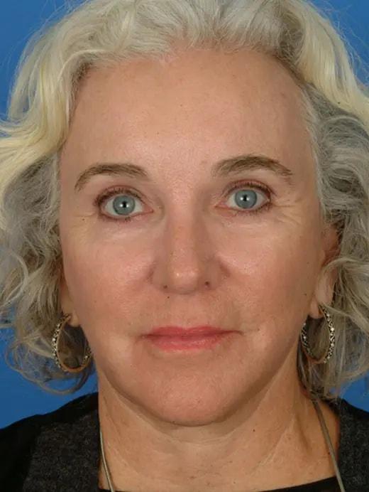 Facial Plastic Surgery Associates facelift after — Houston, TX