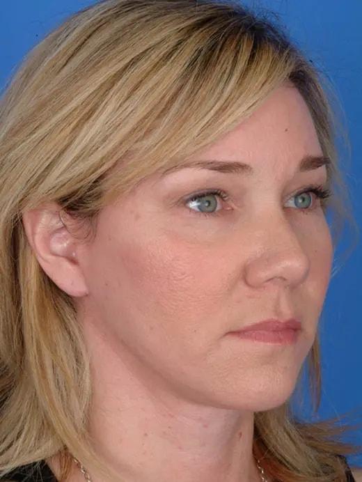 Facial Plastic Surgery Associates facelift after — Houston, TX