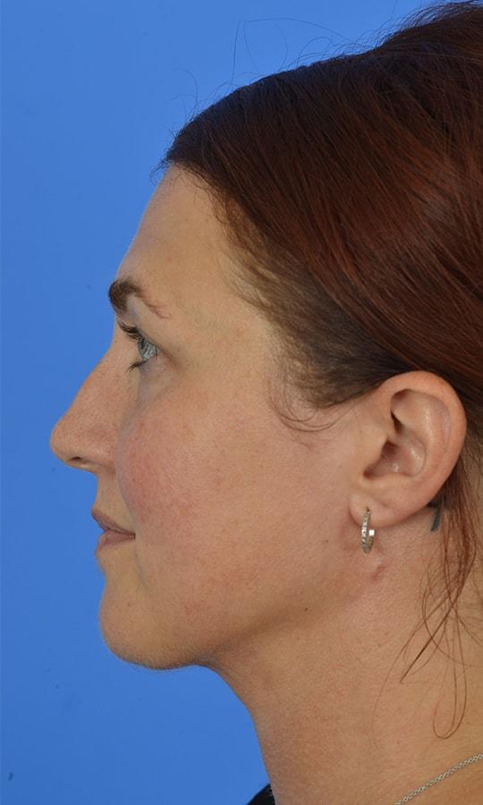 Facial Plastic Surgery Associates neck liposuction after — Houston, TX