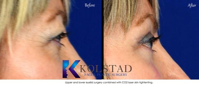 Blepharoplasty result at Kolstad Facial Plastic Surgery in San Diego, CA