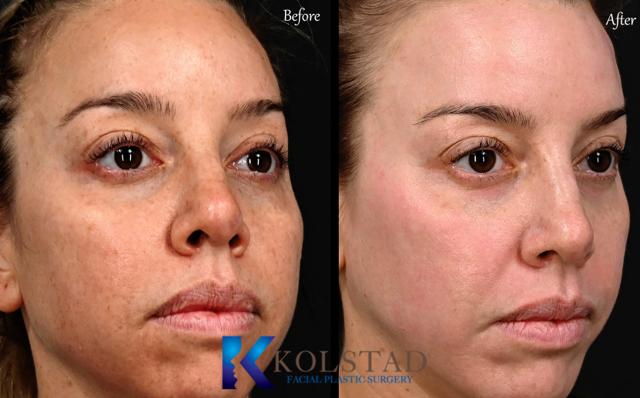 Laser Skin Resurfacing result at Kolstad Facial Plastic Surgery in San Diego, CA