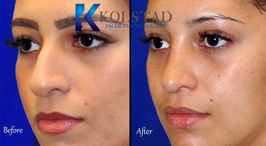 Kolstad Facial Plastic Surgery rhinoplasty result — San Diego, CA