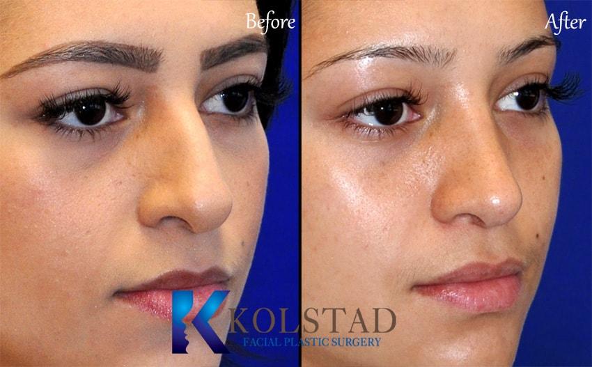 Kolstad Facial Plastic Surgery rhinoplasty result — San Diego, CA