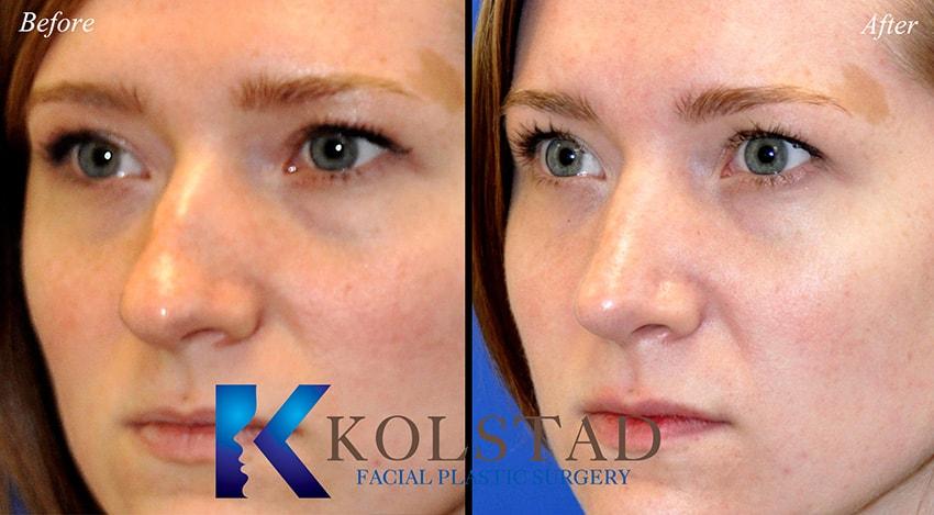 Kolstad Facial Plastic Surgery rhinoplasty result — San Diego, CA