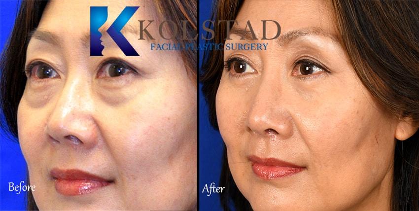Kolstad Facial Plastic Surgery rhinoplasty result — San Diego, CA