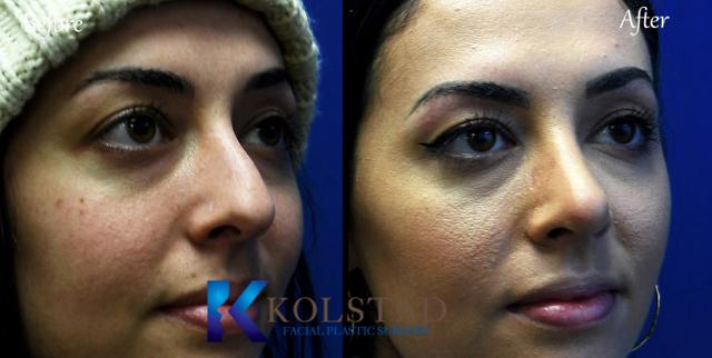 Functional Rhinoplasty result at Kolstad Facial Plastic Surgery in San Diego, CA