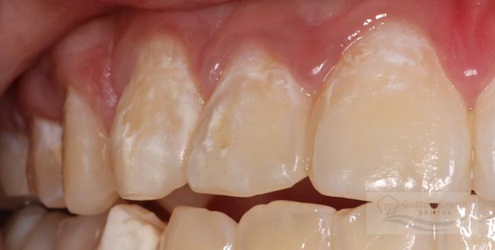 Cotton Creek Dental veneers after — Washington, UT