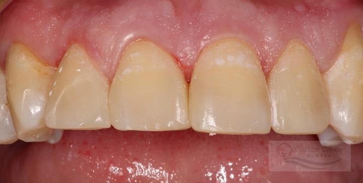 Cotton Creek Dental veneers after — Washington, UT