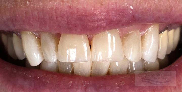 Cotton Creek Dental veneers after — Washington, UT