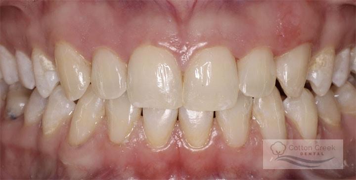 Cotton Creek Dental dental bonding after — Washington, UT