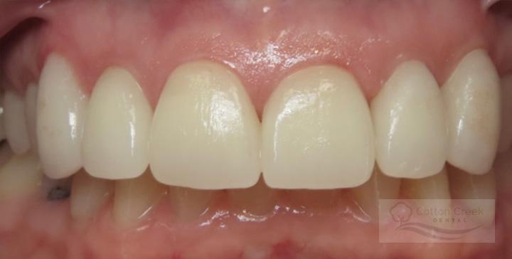 Cotton Creek Dental veneers after — Washington, UT