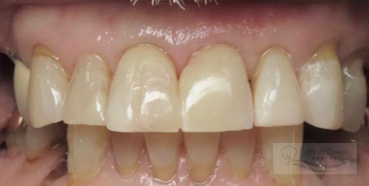 Cotton Creek Dental dental bonding after — Washington, UT
