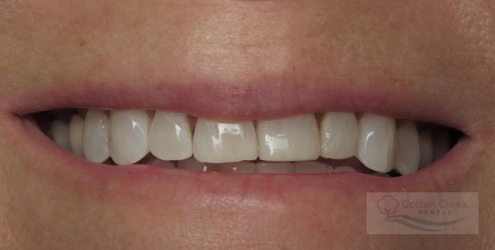Cotton Creek Dental dental bonding after — Washington, UT