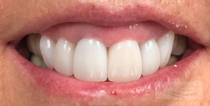 Cotton Creek Dental dental crowns after — Washington, UT