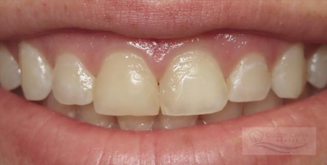 Dental Veneers before at Cotton Creek Dental in Washington, UT