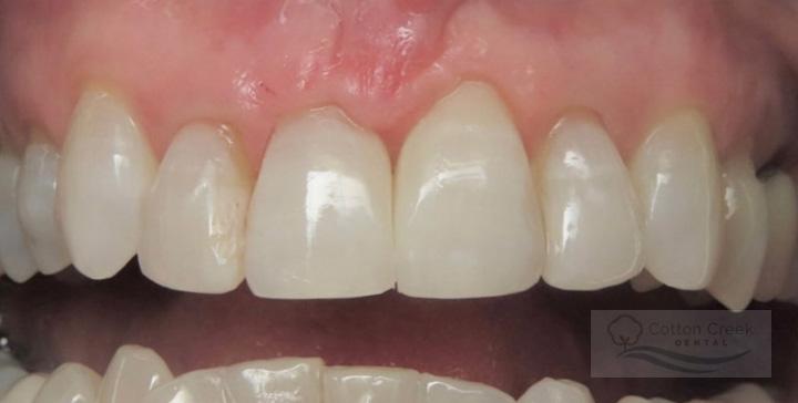 Cotton Creek Dental dental bonding after — Washington, UT