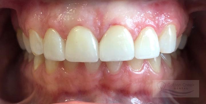 Cotton Creek Dental dental crowns after — Washington, UT