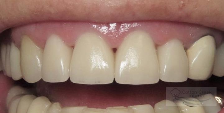 Cotton Creek Dental dental crowns after — Washington, UT