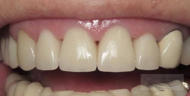 Dental Implants after at Cotton Creek Dental in Washington, UT