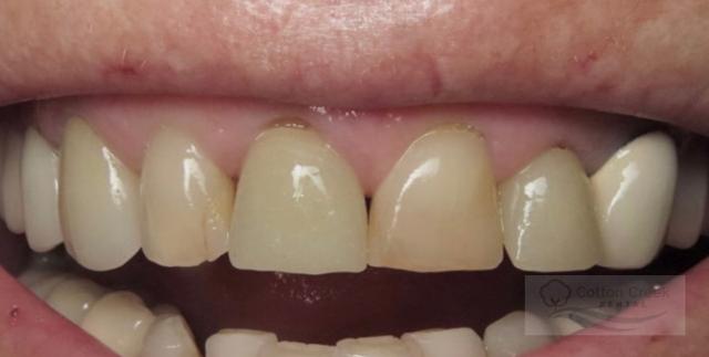 Dental Implants before at Cotton Creek Dental in Washington, UT