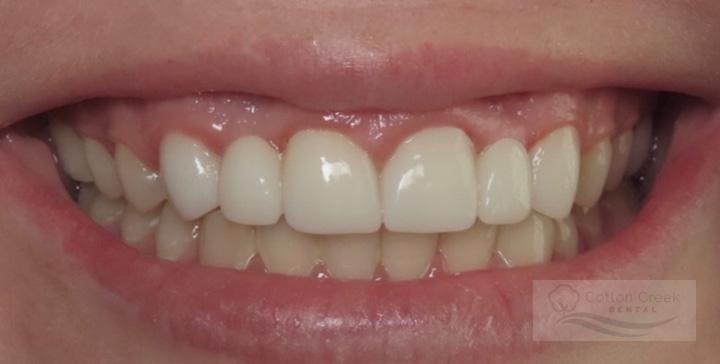Cotton Creek Dental dental crowns after — Washington, UT