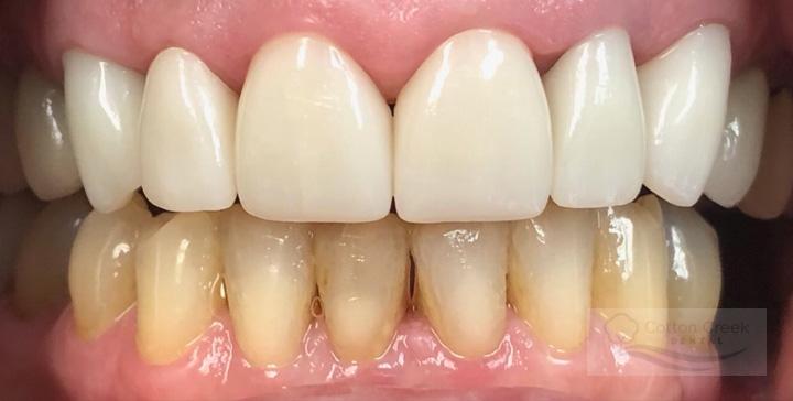 Cotton Creek Dental dental crowns after — Washington, UT