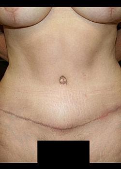 Long Island Plastic Surgical Group tummy tuck after — Garden City, NY