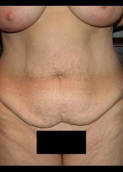 Mini Tummy Tuck before at Long Island Plastic Surgical Group in Garden City, NY