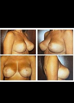 Long Island Plastic Surgical Group breast lift after — Garden City, NY