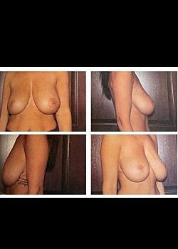 Breast Lift before at Long Island Plastic Surgical Group in Garden City, NY