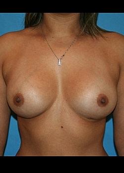 Long Island Plastic Surgical Group breast augmentation after — Garden City, NY