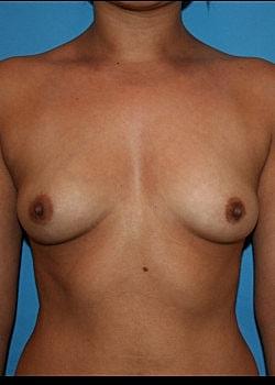Fat Transfer Breast Augmentation before at Long Island Plastic Surgical Group in Garden City, NY