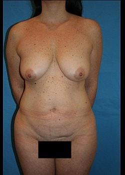 Mommy Makeover before at Long Island Plastic Surgical Group in Garden City, NY
