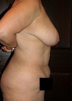 Mommy Makeover before at Long Island Plastic Surgical Group in Garden City, NY