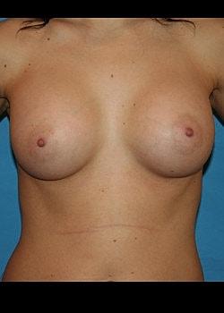 Long Island Plastic Surgical Group breast augmentation after — Garden City, NY