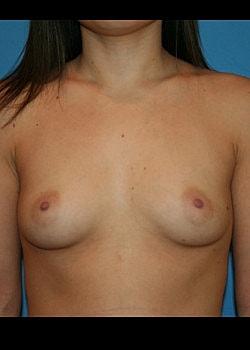 Fat Transfer Breast Augmentation before at Long Island Plastic Surgical Group in Garden City, NY