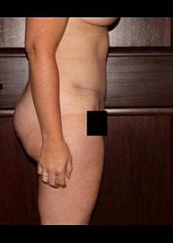 Long Island Plastic Surgical Group tummy tuck after — Garden City, NY