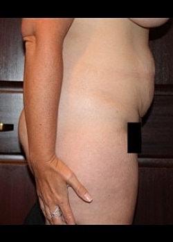 Mini Tummy Tuck before at Long Island Plastic Surgical Group in Garden City, NY