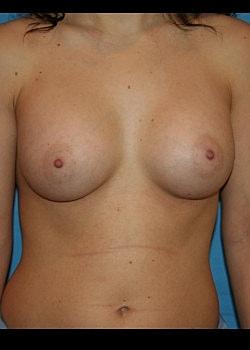 Long Island Plastic Surgical Group breast augmentation after — Garden City, NY