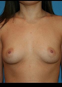 Fat Transfer Breast Augmentation before at Long Island Plastic Surgical Group in Garden City, NY