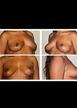 Long Island Plastic Surgical Group breast lift after — Garden City, NY