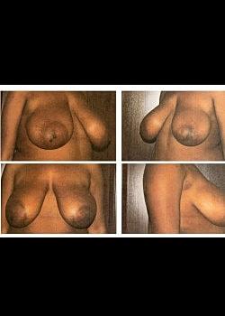 Breast Reduction before at Long Island Plastic Surgical Group in Garden City, NY
