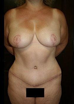 Long Island Plastic Surgical Group mommy makeover after — Garden City, NY