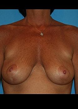 Fat Transfer Breast Augmentation before at Long Island Plastic Surgical Group in Garden City, NY