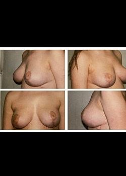 Long Island Plastic Surgical Group breast lift after — Garden City, NY