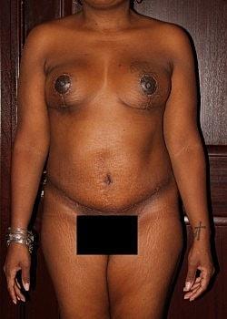 Long Island Plastic Surgical Group mommy makeover after — Garden City, NY
