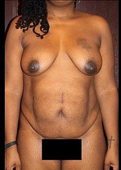 Mommy Makeover before at Long Island Plastic Surgical Group in Garden City, NY