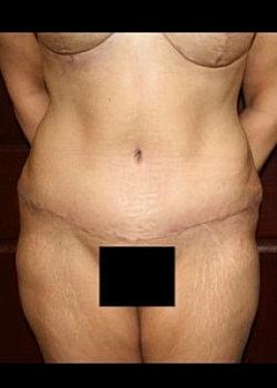 Long Island Plastic Surgical Group tummy tuck after — Garden City, NY